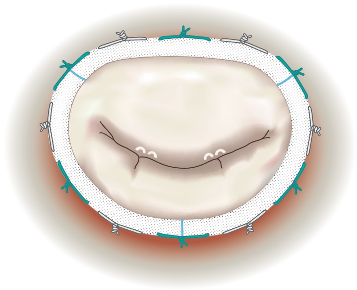 AML Repair3